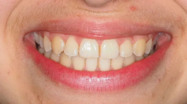 dientes4