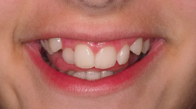 dientes6